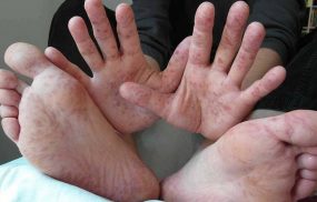Bệnh tổ đỉa: Nguyên nhân, Triệu chứng và cách trị dứt điểm