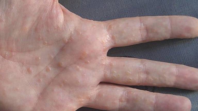 Bệnh tổ đỉa có nguy hiểm không?