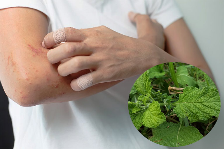 chữa viêm da cơ địa bằng cây vòi voi