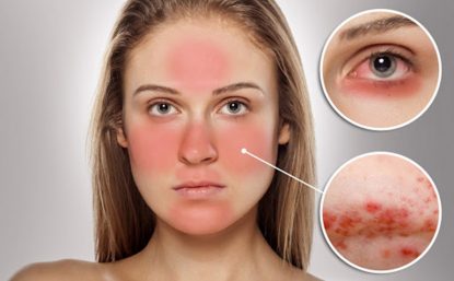 dị ứng mỹ phẩm