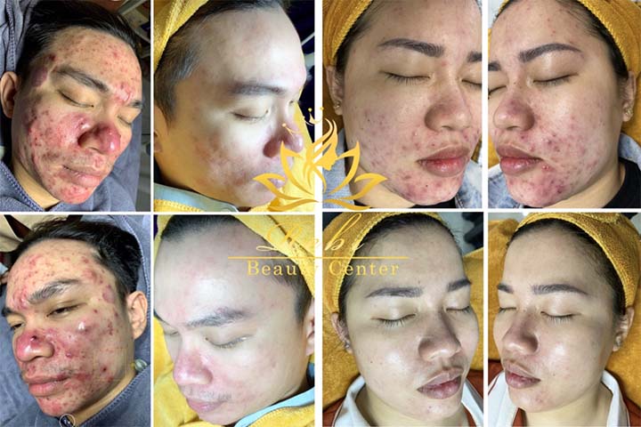 Hình ảnh trị mụn uy tín tại TPHCM 