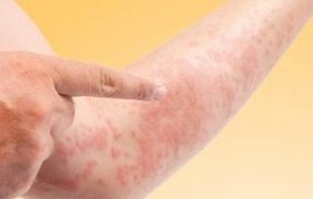 Mề đay vật lý là gì?
