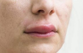 Ngủ dậy bị sưng môi trên là do đâu?