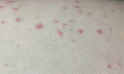 Nổi chấm đỏ trên da như nốt ruồi son là bị gì? Có nguy hiểm?