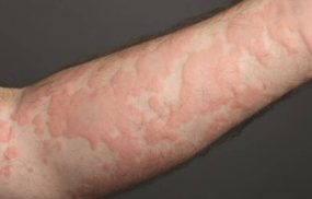 Nổi mẩn ngứa thành mảng trên da do đâu?