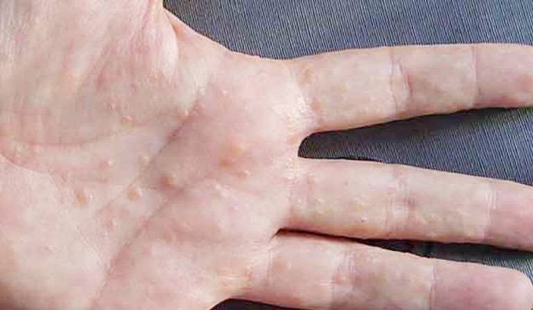 Nổi mụn nước ngứa ở chân tay là bệnh gì? Làm sao hết?