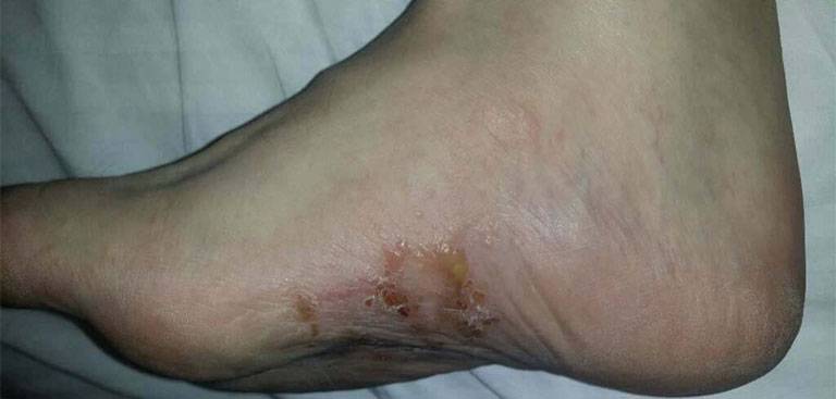 Nổi mụn nước ngứa ở chân tay là triệu chứng của bệnh tổ đỉa