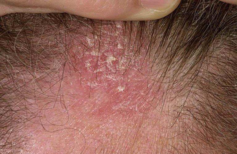 Viêm da dầu ở đầu gây rụng tóc