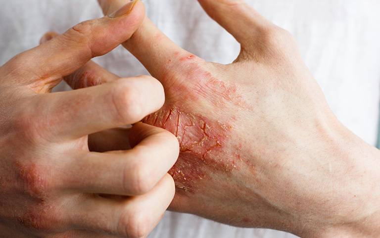 Viêm da tiếp xúc bao lâu thì khỏi?