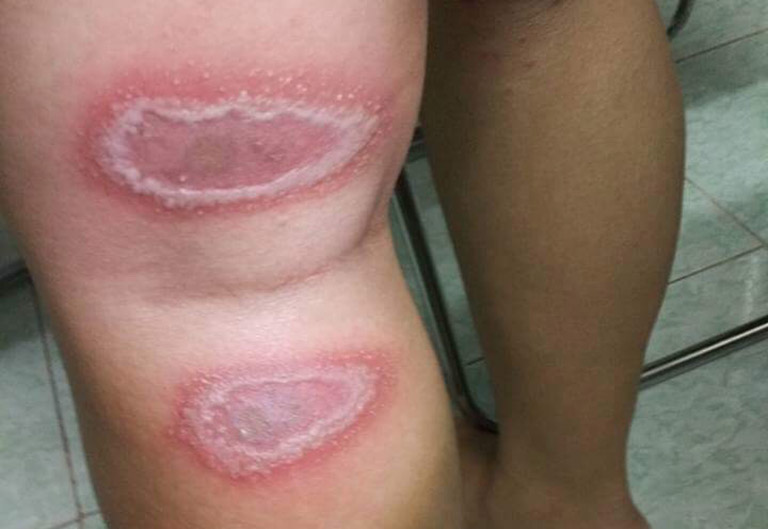 Viêm da tiếp xúc do côn trùng