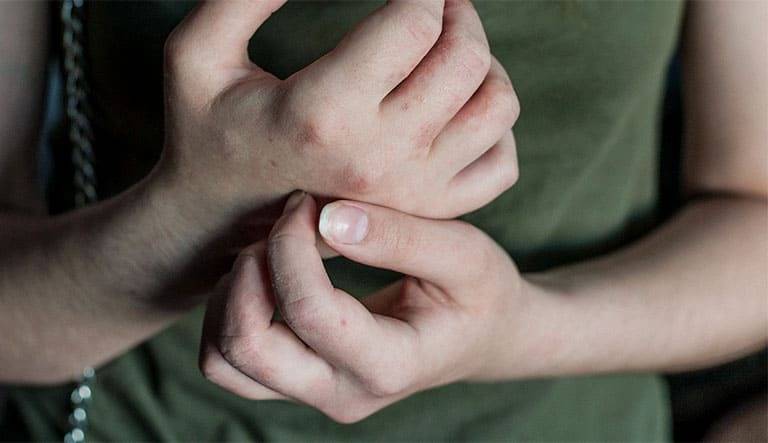 Bệnh tổ đỉa có lây không? Có di truyền không?