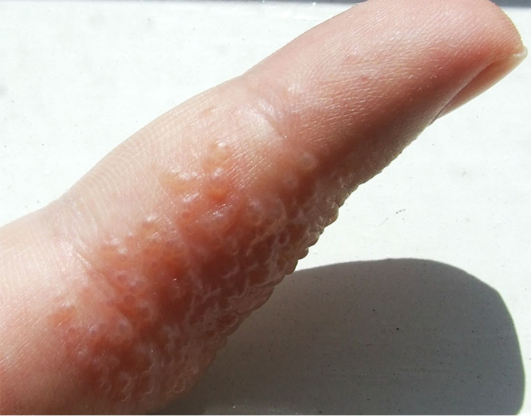 công dụng của muối trong việc chữa bệnh tổ đỉa
