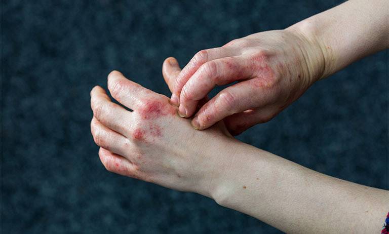 Bệnh chàm đồng tiền nguy hiểm không? Có lây không?