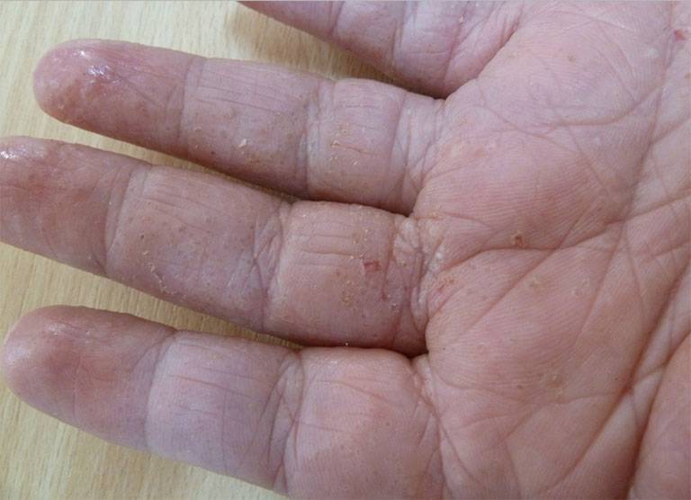Tác dụng của lá lốt trong chữa bệnh tổ đỉa