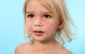 Dị ứng thời tiết ở trẻ em: Biểu hiện, hướng điều trị và lưu ý