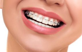 Top 10 địa chỉ niềng răng uy tín hàng đầu tại TPHCM