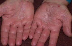 Bệnh Á sừng: Nguyên nhân, Triệu chứng, Cách điều trị