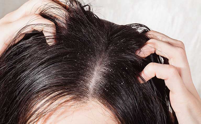 Dấu hiệu nhân biết bệnh á sừng da đầu