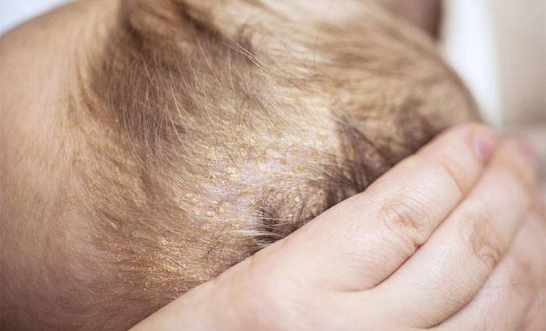Dấu hiệu nhận biết bệnh chàm da đầu ở trẻ em