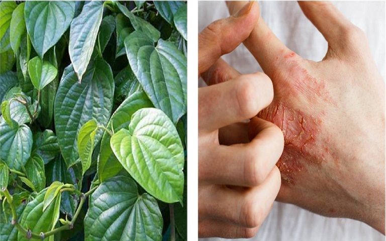 Chữa á sừng bằng lá trầu không