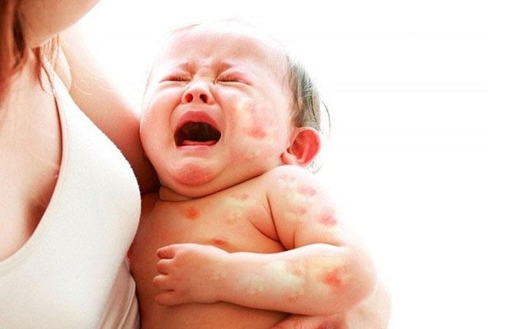 Dị ứng sữa mẹ là gì?