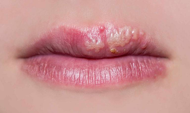 Nổi mụn nước ở môi là bị gì? Bôi thuốc gì nhanh khỏi?