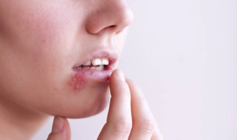 Bệnh Herpes mở miệng