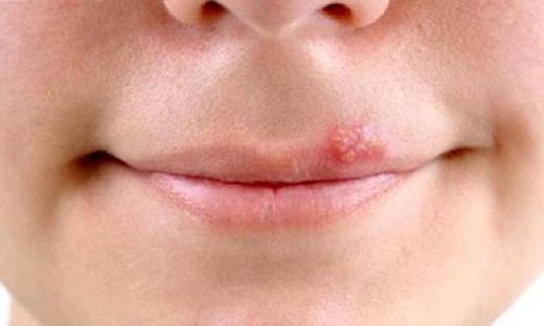 Phản ứng dị ứng