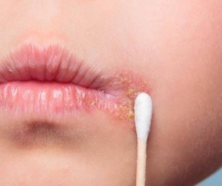 Sử dụng thuốc Tây điều trị 