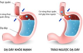 Trào ngược dạ dày thực quản