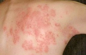 Viêm da dị ứng: Nguyên nhân, Triệu chứng, Cách điều trị