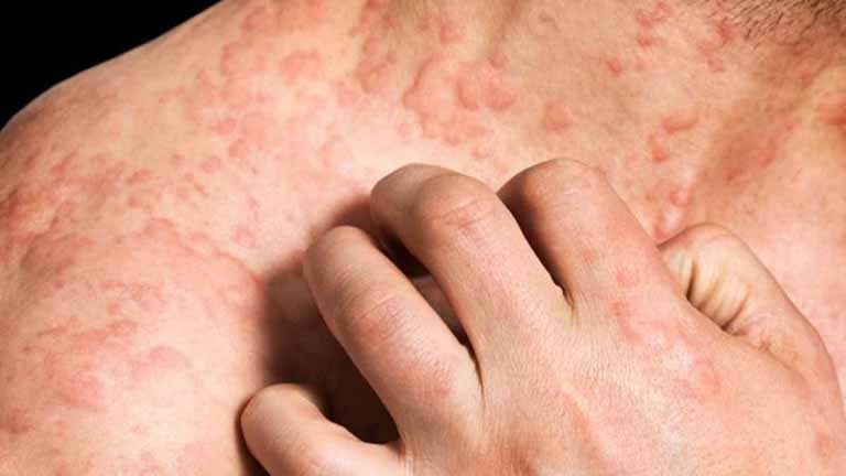7 Cách giảm ngứa khi bị viêm da cơ địa cực đơn giản tại nhà