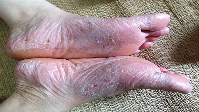 Bệnh á sừng ở chân