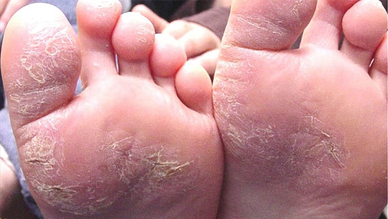 Bệnh á sừng ở chân