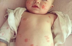 Bệnh vảy nến ở trẻ sơ sinh: Dấu hiệu, chăm sóc và điều trị