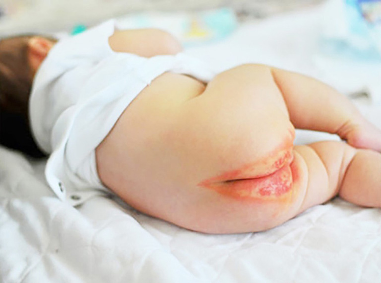cách chữa hăm cho trẻ sơ sinh