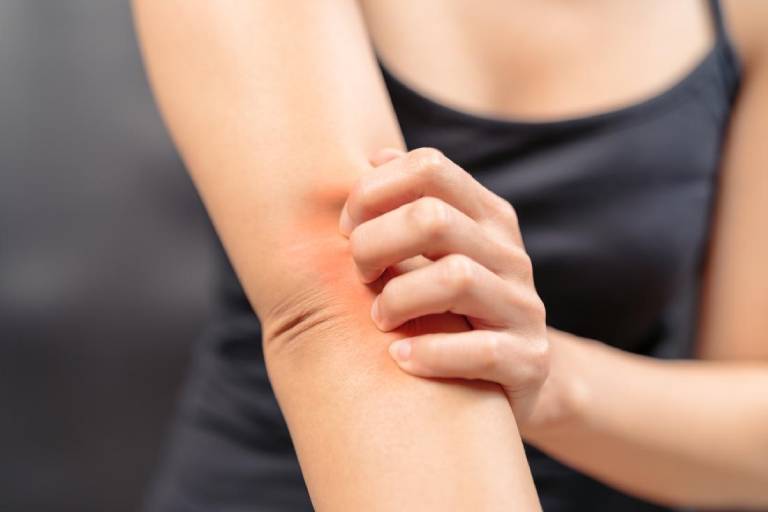 Bệnh viêm da tiếp xúc