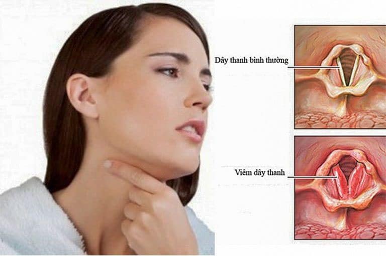 Đau họng nhức đầu mệt mỏi