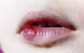 Môi bị sưng 1 cục: Nguyên nhân và cách xử lý hiệu quả