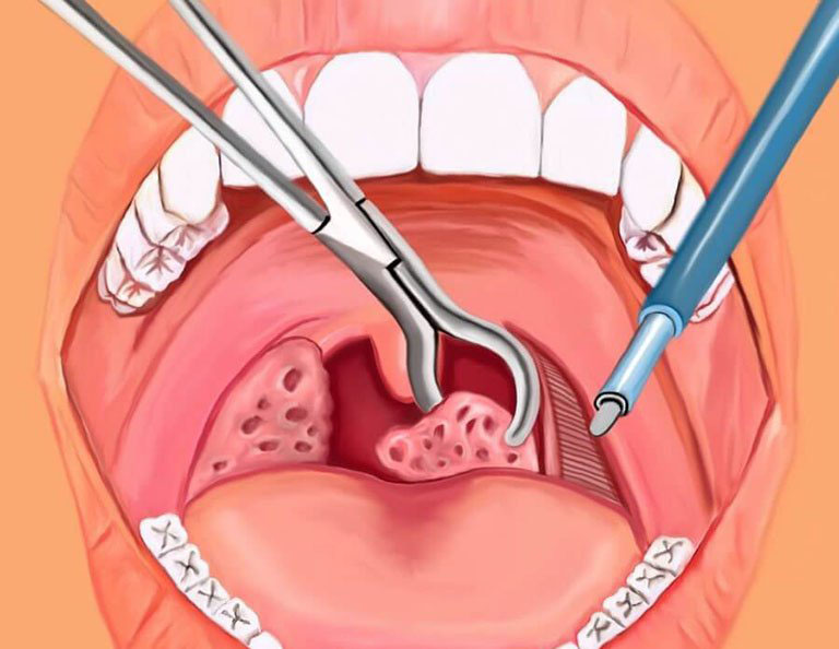 Viêm amidan ở trẻ em