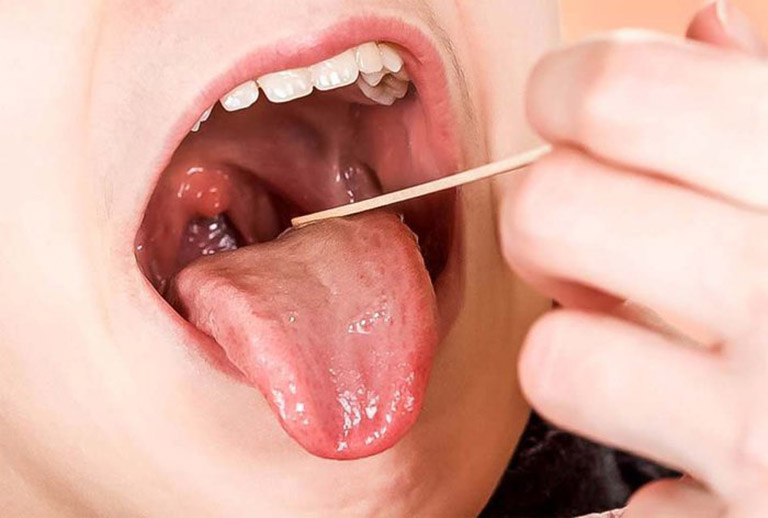 Viêm amidan ở trẻ