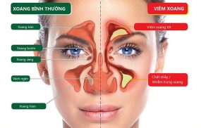 viêm xoang bướm