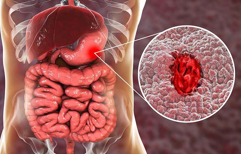 Cách chăm sóc người bị xuất huyết dạ dày
