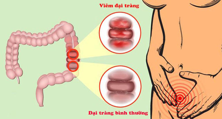 đau thượng vị bên trái