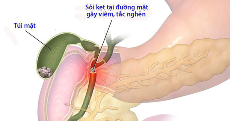 Đau thượng vị từng cơn