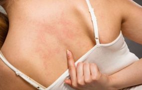 Gan yếu nổi mề đay: Biểu hiện nhận biết và hướng điều trị