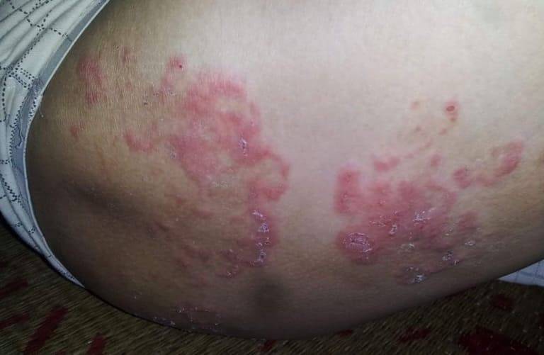 Dấu hiệu nhận biết hắc lào ở mông
