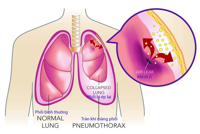 sốt xuất huyết Dengue ở trẻ em
