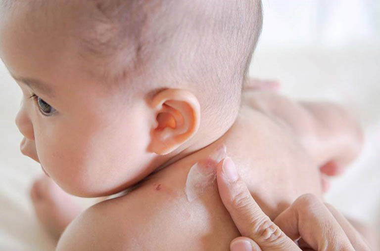 Làm gì khi trẻ sơ sinh mắc bệnh hắc lào?
