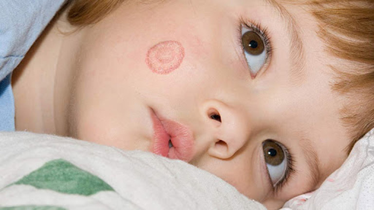 Điều trị bệnh hắc lào ở trẻ sơ sinh